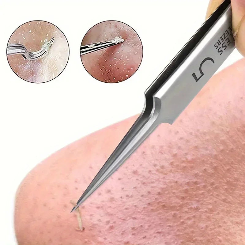 Extra Fine No. 5 Blackhead Tweezers - Precision Acne Removal Tool