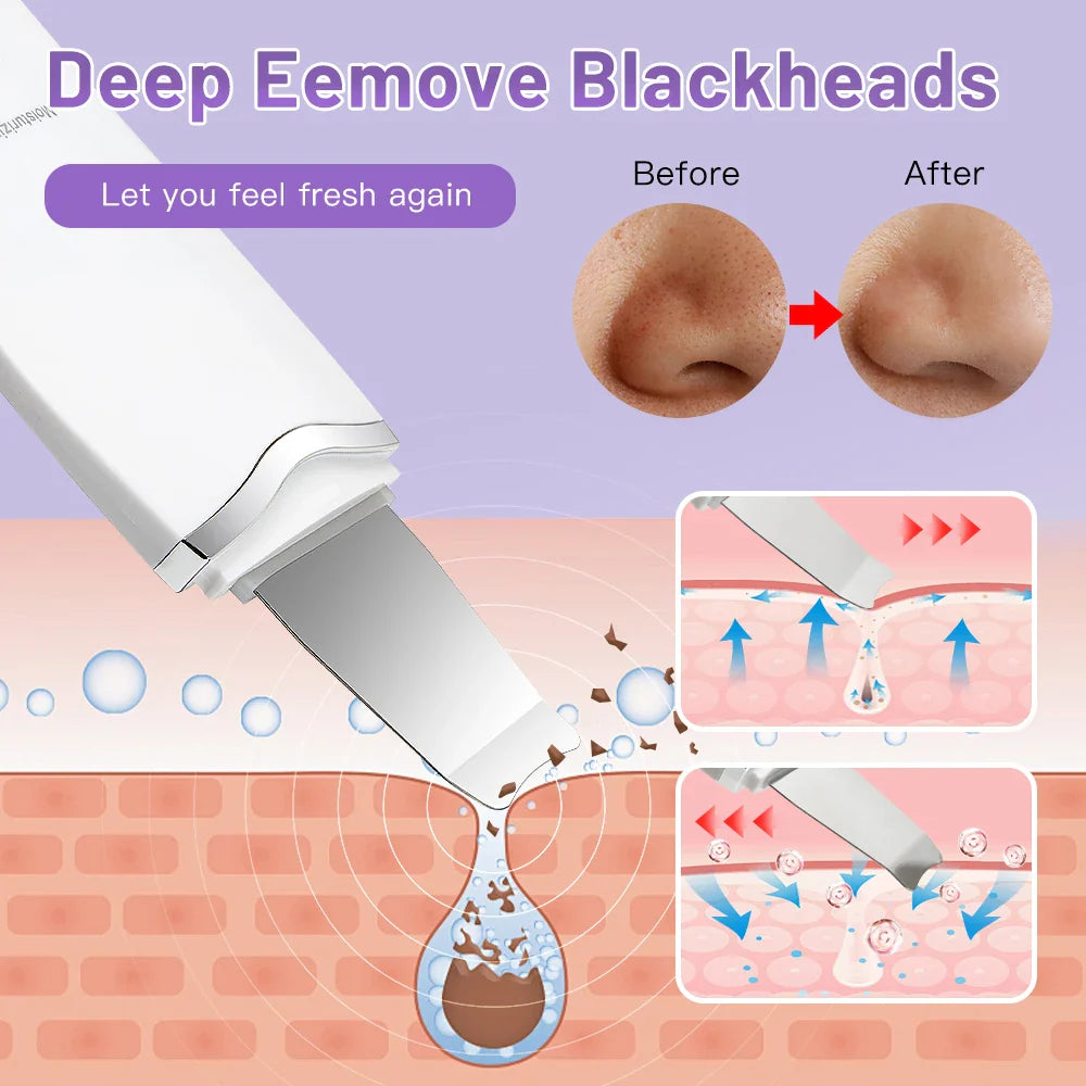 Electric Ultrasonic Skin Scrubber - Blackhead Remover & Facial Lifting Tool