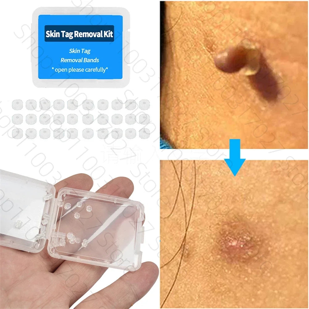 30pcs Skin Tag Remover Rubber Rings - Non-Toxic & Painless Wart Removal