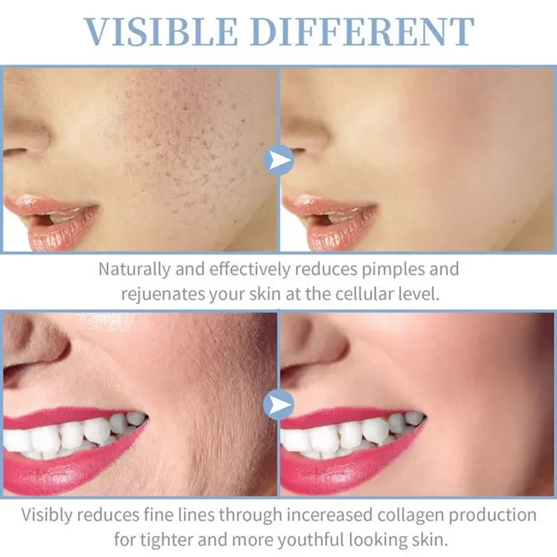 4 In 1 Electric Facial Wand for Acne & Skin Tightening - High Frequency Therapy