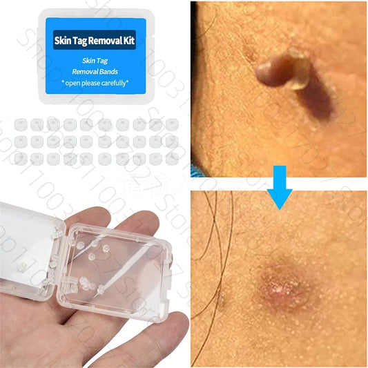 30pcs Skin Tag Remover Rubber Rings - Non-Toxic & Painless Wart Removal