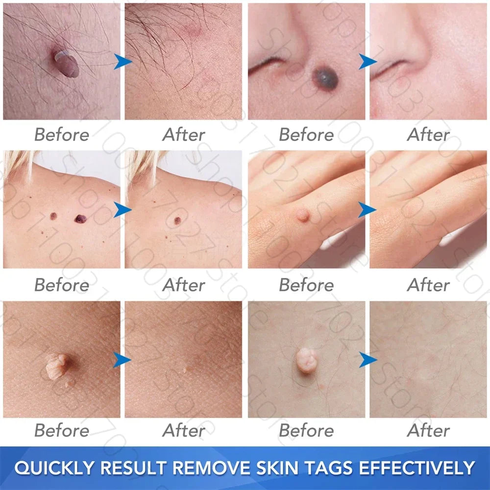 30pcs Skin Tag Remover Rubber Rings - Non-Toxic & Painless Wart Removal