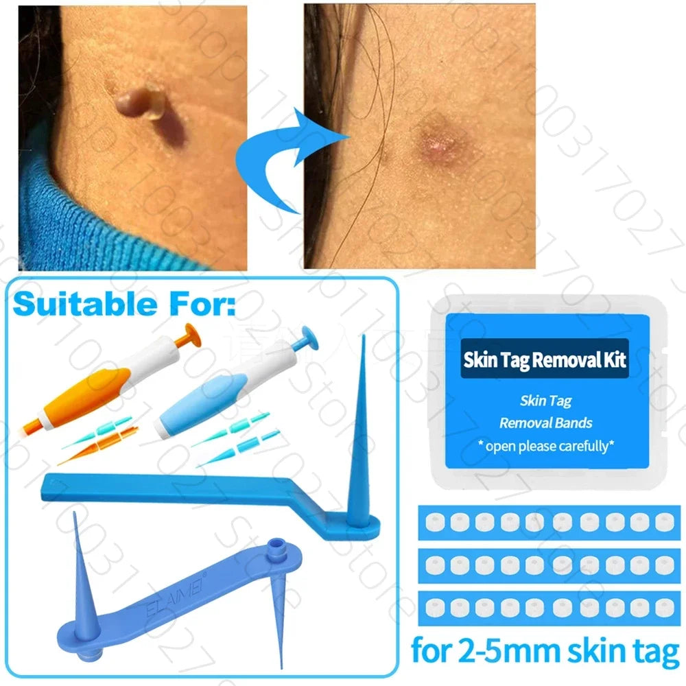 30pcs Skin Tag Remover Rubber Rings - Non-Toxic & Painless Wart Removal